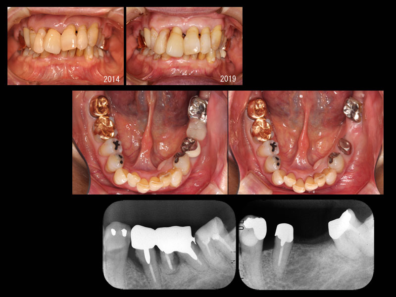 欠損の流れ【18】｜お知らせ | 早田歯科医院